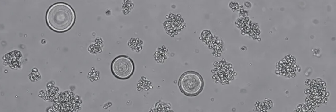 dieta baja en oxalatos